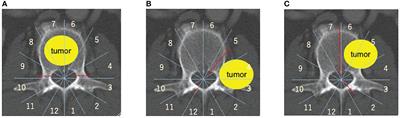 A new era in the management of spinal metastasis